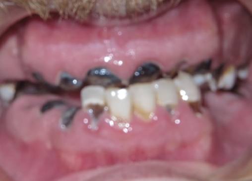 Missing full row of top teeth and partial bottom arch before all on 4 fixed dental implant dentures