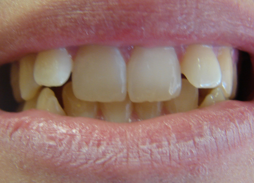 Top teeth pointing forward in smile line before powerprox six month braces