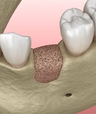 Animated bone graft visible in gum line