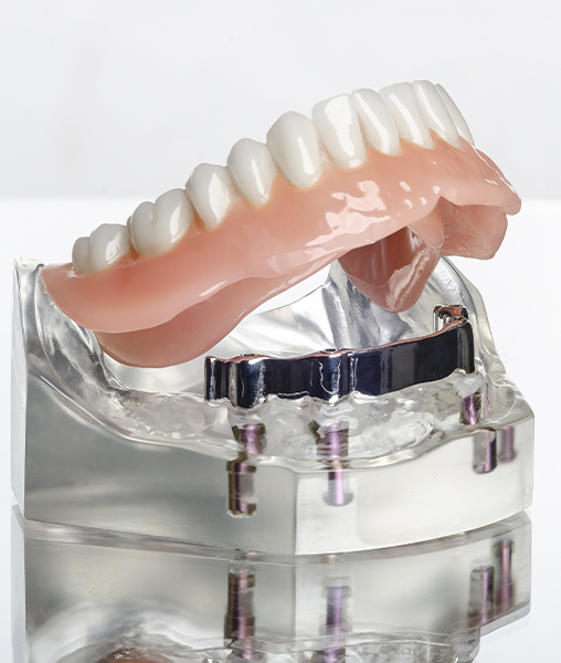 Model smile with snap on denture