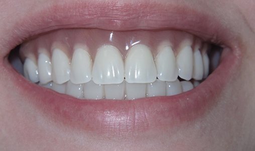 Patient’s beautiful smile after Teeth in a Day treatment