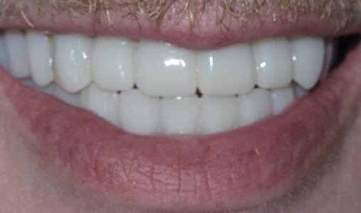 Patient’s attractive, healthy smile after All on 4