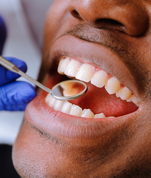 Dentist checking smile's tooth-colored fillings