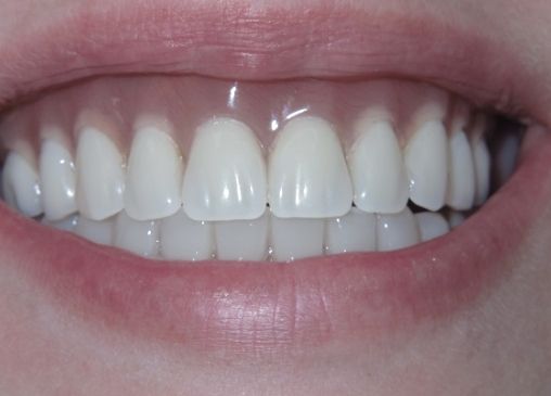 Beautiful smile after all on 4 fixed denta implant dentures