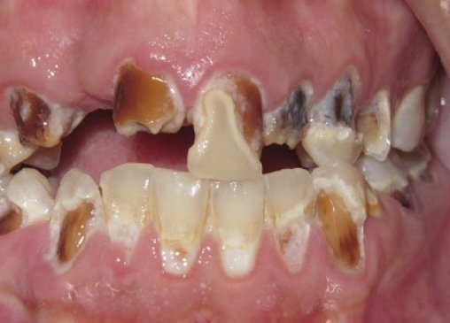 Severely damaged and decayed teeth before all on 4 fixed dental implant dentures