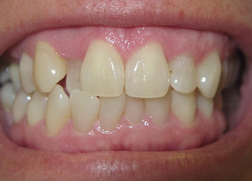 Canine tooth sitting behind surrounding teeth before powerprox six month braces