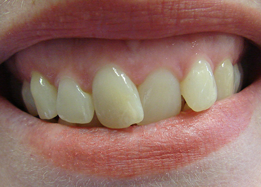Overlapping top teeth before powerprox six month braces