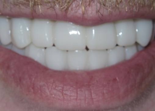 Perfect smile after all on 4 fixed dental implant dentures