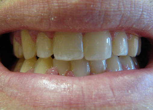 Properly aligned smilea after powerprox six month braces