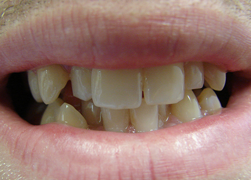 Misaligned smile before powerprox six month braces