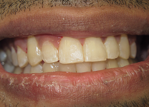 Aligned teeth after powerprox six month braces
