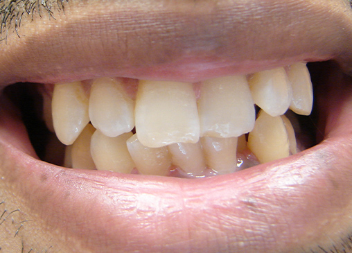 Crooked teeth before powerprox six month braces