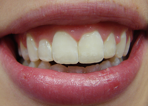 Aligned front teeth after powerprox six month braces