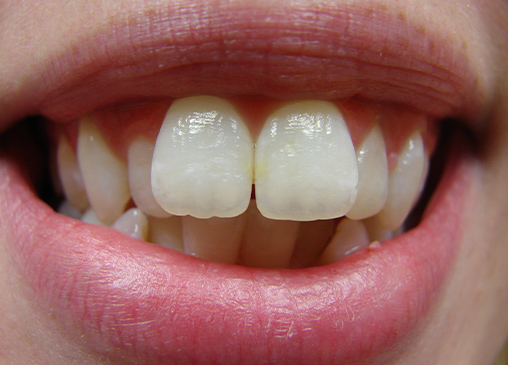Protruding front teeth before powerprox six month braces