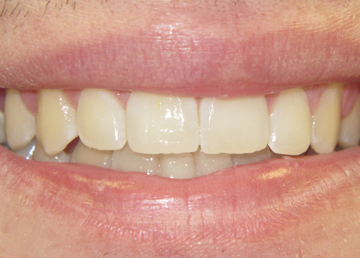 all teeth aligned correcting after powerprox six month braces