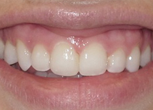 Evenly spaced teeth after powerprox six month braces