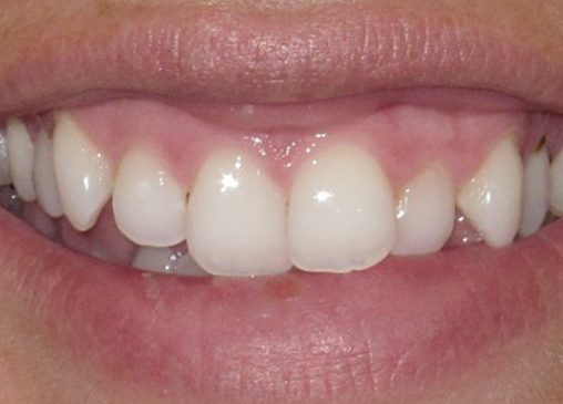 Unevenly spaced teeth before powerprox six month braces