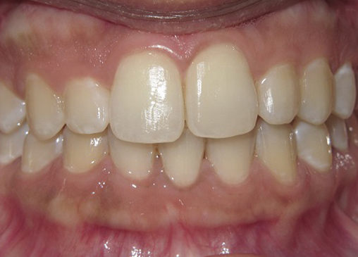 Perfectly aligned and spaced teeth after powerprox six month braces