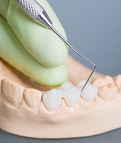 Model smile with metal free dental bridge