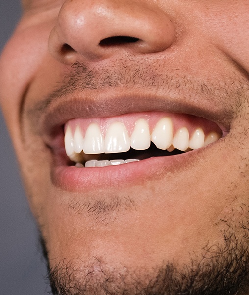 Closeup of smile after gum recontouring