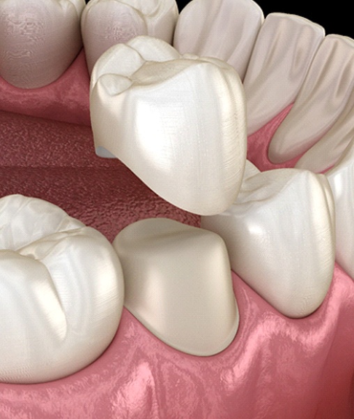 Illustration of porcelain crown being placed on lower tooth