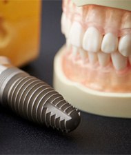 ental implants sitting next to a model of a mouth 