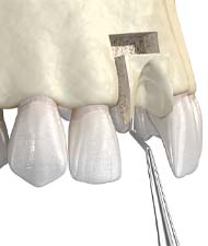 Illustration of block bone graft, a preliminary treatment before dental implants