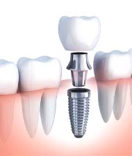 Illustration of single dental implant, abutment, and crown
