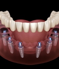 Aniamted all on 6 dental implant denture placement