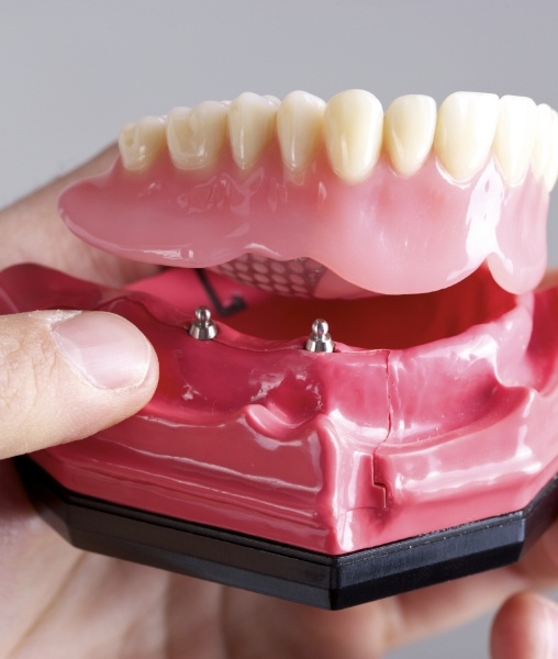 Model dental implant supported denture