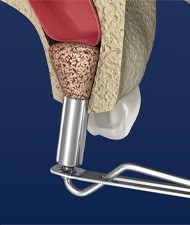 Animated sinus lift bone graft process