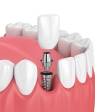 Animated implant supported dental crown