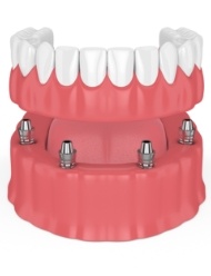 Animated implant supported dental crown