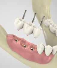 Animated mini dental implant tooth replacement process