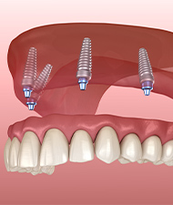 Animated all on 4 dental implant denture placement