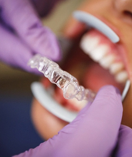 Dentist in York placing Invisalign on patient's teeth