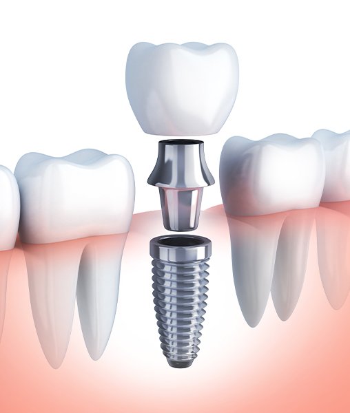 Animated dental implant supported replacement tooth