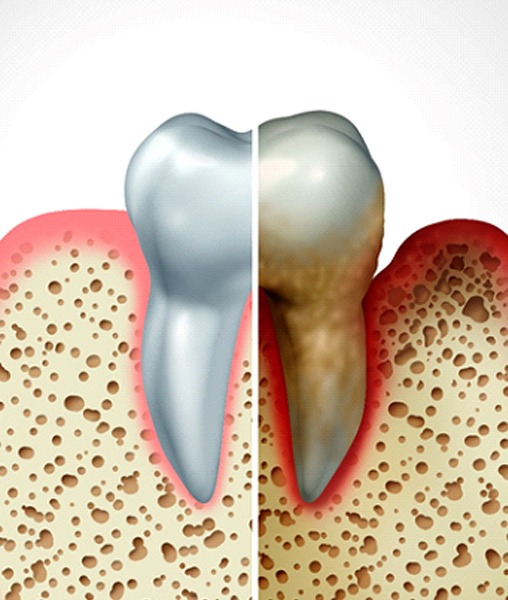 Healthy gums vs gums needing periodontal therapy in York