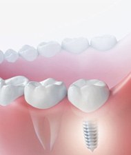 Illustration of dental implant next to natural tooth