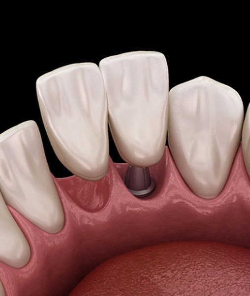 Illustration of dental implant bridge to replace two teeth