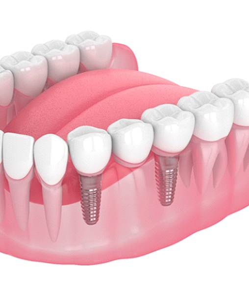 Illustration of dental implant bridge to replace three teeth