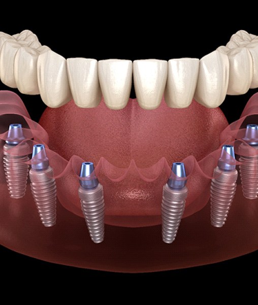 Illustration of implant-retained dentures for lower dental arch