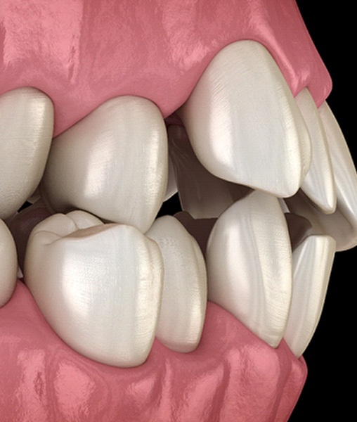 digital diagram of crooked teeth before SureSmile in York