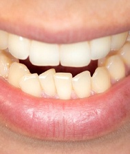 Closeup of patient with crooked teeth in York before SureSmile
