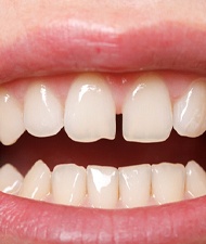 Closeup of patient with gap between front teeth in York before SureSmile