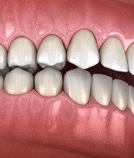 CDigital diagram of an overbite in York before SureSmile
