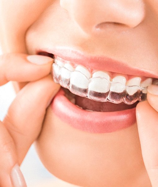 Closeup of patient wearing SureSmile aligners in York