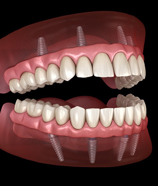 Illustration of all-on-4