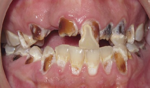 Patient’s broken, decayed teeth before All on 4 treatment