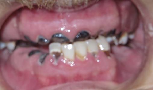 Patient’s missing and damaged teeth before All on 4 procedure